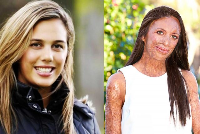 turia pitt before and after
